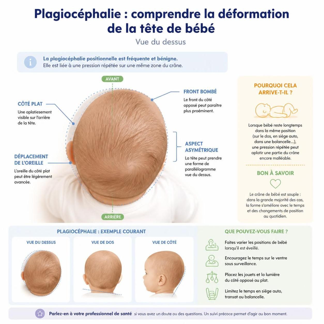 découvrez comment prévenir et corriger la plagiocéphalie, ou tête plate, chez votre bébé grâce à des conseils pratiques et des solutions adaptées.
